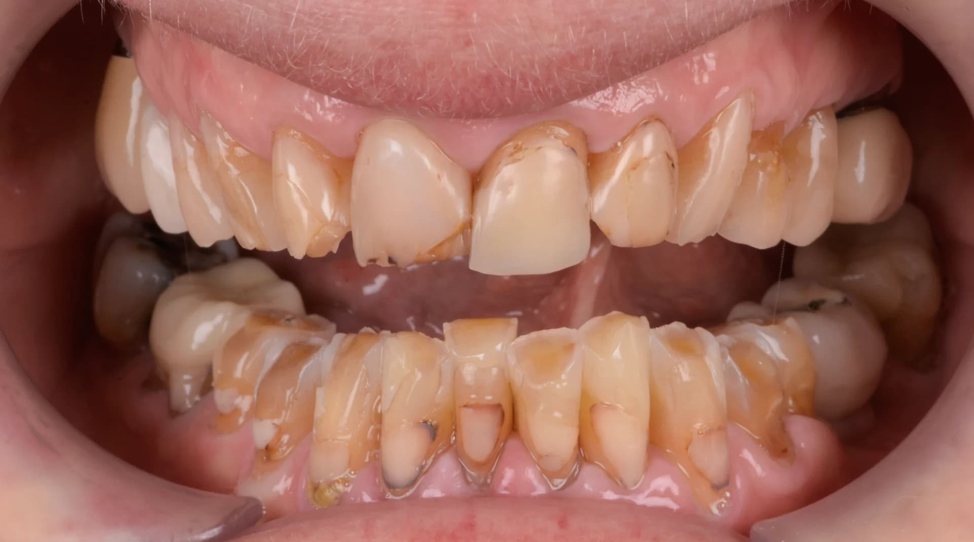 prothèses dentaires fixes - Before