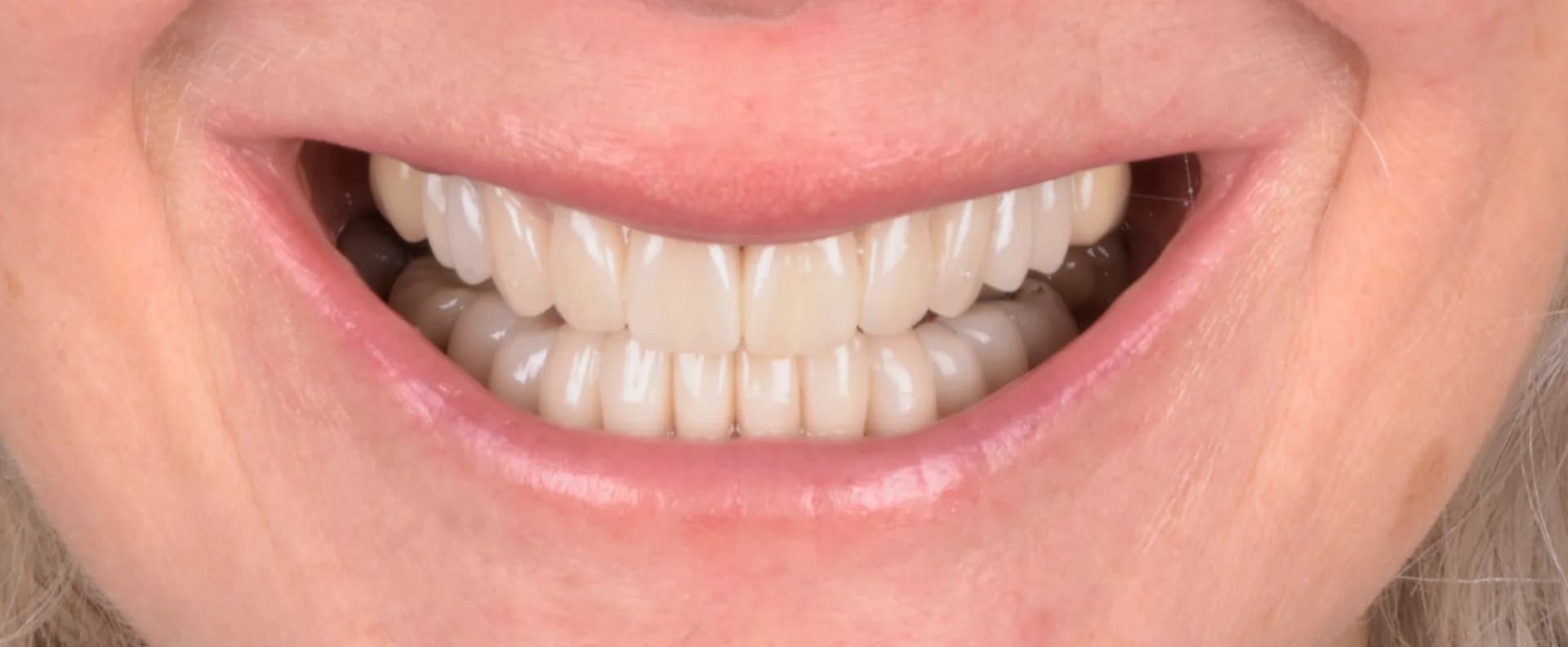prothèses dentaires fixes - After